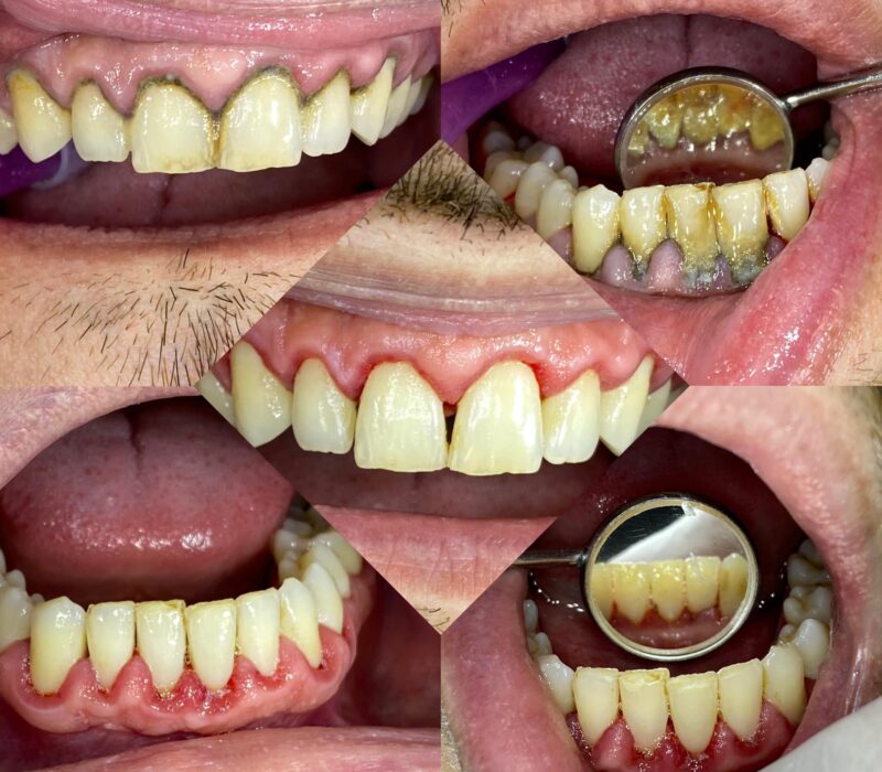 Profilaxie
