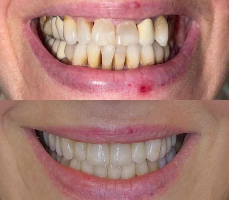 Before and After